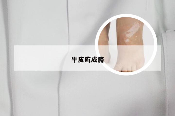牛皮癣成瘾