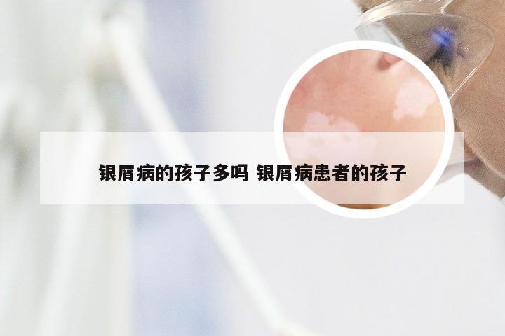 银屑病的孩子多吗 银屑病患者的孩子