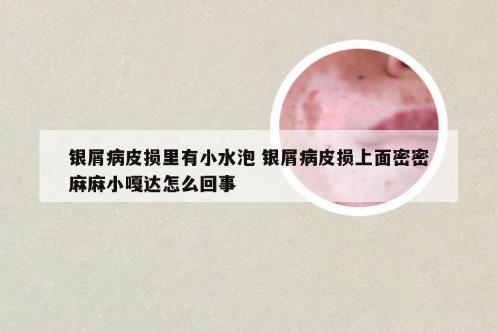 银屑病皮损里有小水泡 银屑病皮损上面密密麻麻小嘎达怎么回事