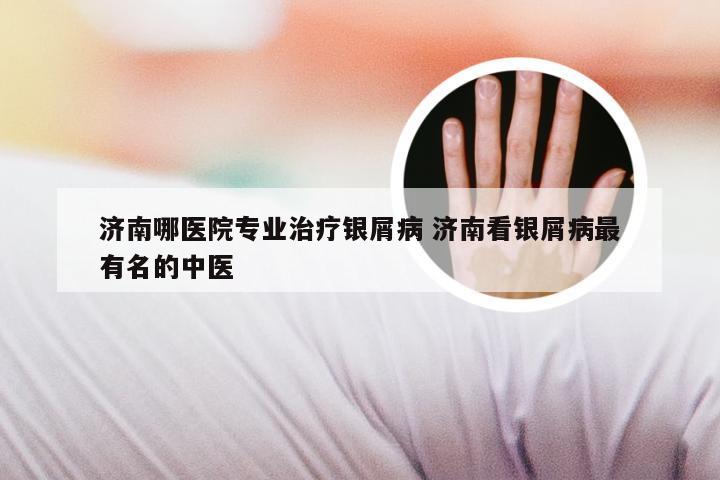 济南哪医院专业治疗银屑病 济南看银屑病最有名的中医