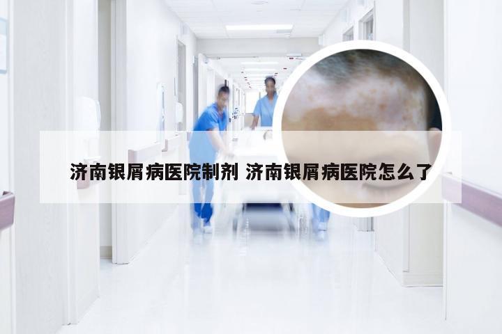 济南银屑病医院制剂 济南银屑病医院怎么了