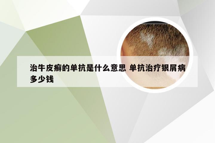 治牛皮癣的单抗是什么意思 单抗治疗银屑病多少钱