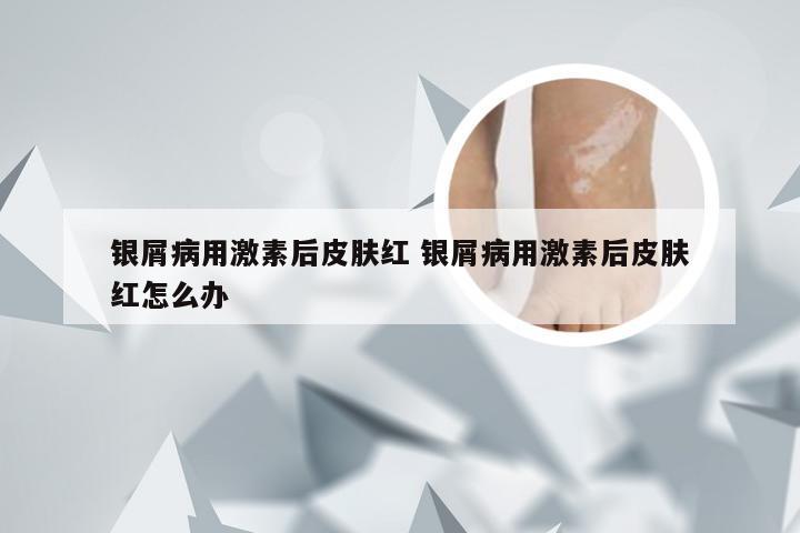 银屑病用激素后皮肤红 银屑病用激素后皮肤红怎么办