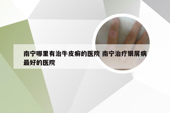 南宁哪里有治牛皮癣的医院 南宁治疗银屑病最好的医院