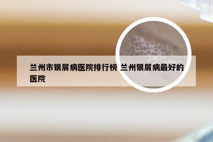 兰州市银屑病医院排行榜 兰州银屑病最好的医院