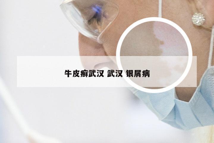 牛皮癣武汉 武汉 银屑病