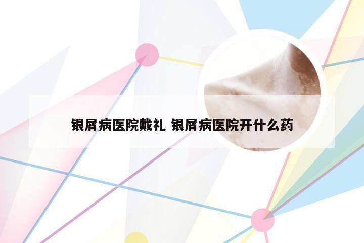 银屑病医院戴礼 银屑病医院开什么药