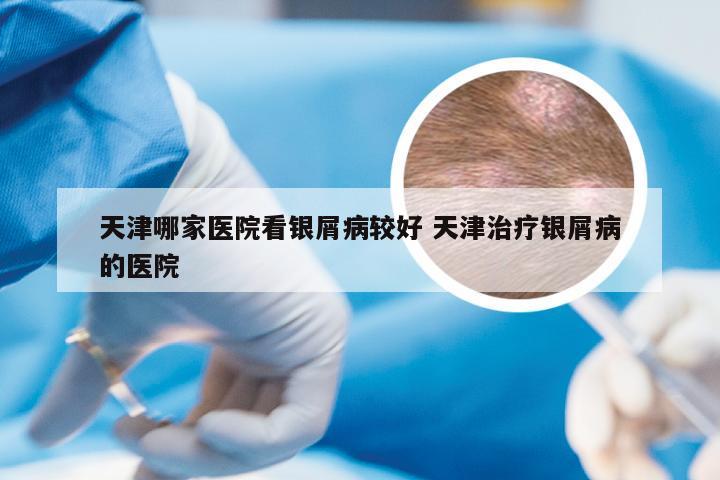 天津哪家医院看银屑病较好 天津治疗银屑病的医院
