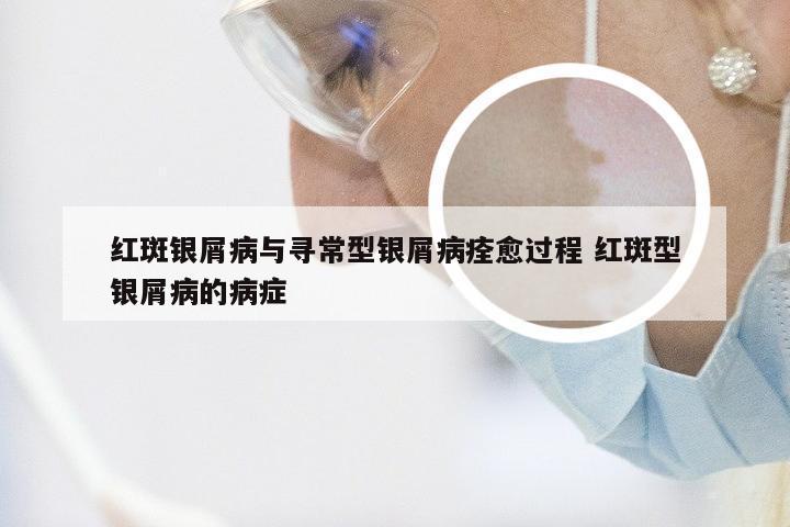 红斑银屑病与寻常型银屑病痊愈过程 红斑型银屑病的病症