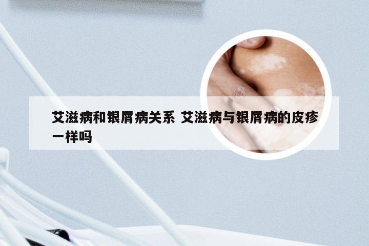 艾滋病和银屑病关系 艾滋病与银屑病的皮疹一样吗