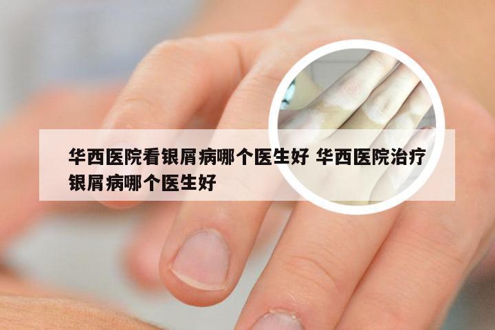 华西医院看银屑病哪个医生好 华西医院治疗银屑病哪个医生好