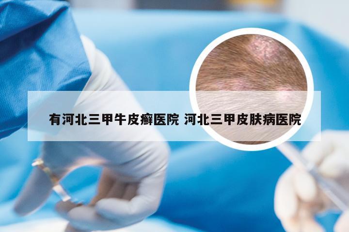 有河北三甲牛皮癣医院 河北三甲皮肤病医院