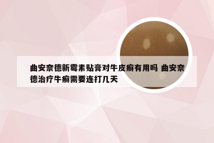 曲安奈德新霉素贴膏对牛皮癣有用吗 曲安奈德治疗牛癣需要连打几天