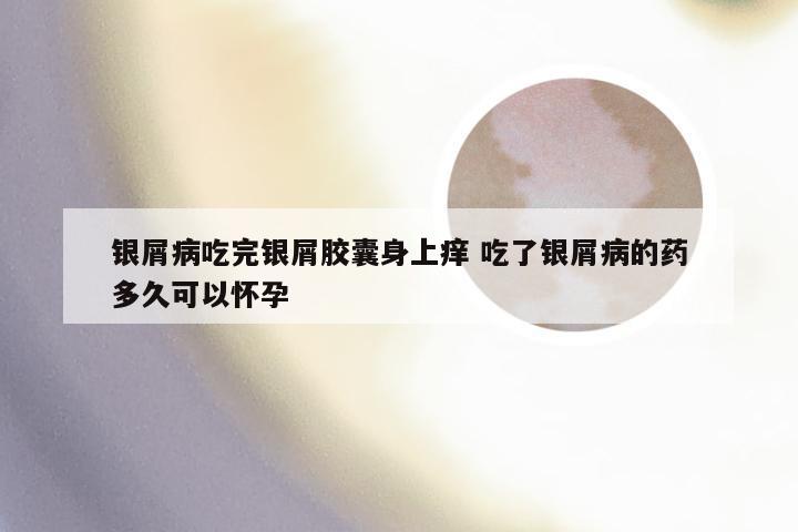 银屑病吃完银屑胶囊身上痒 吃了银屑病的药多久可以怀孕