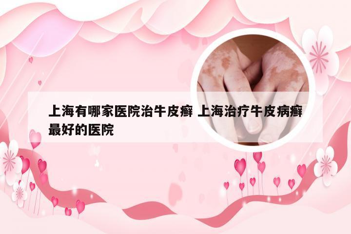 上海有哪家医院治牛皮癣 上海治疗牛皮病癣最好的医院