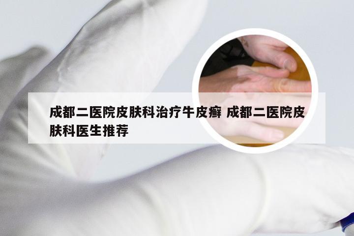 成都二医院皮肤科治疗牛皮癣 成都二医院皮肤科医生推荐