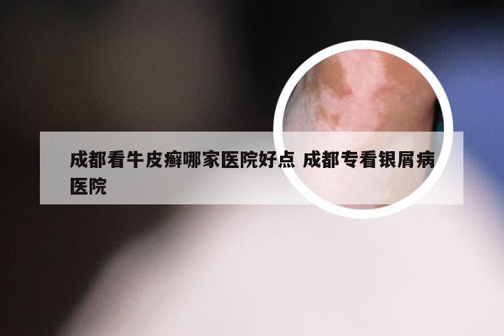 成都看牛皮癣哪家医院好点 成都专看银屑病医院
