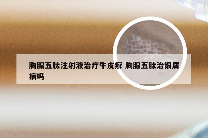 胸腺五肽注射液治疗牛皮癣 胸腺五肽治银屑病吗
