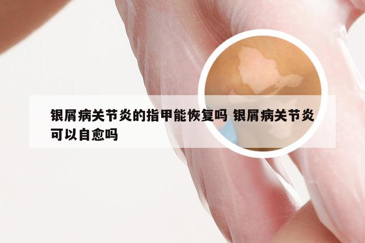 银屑病关节炎的指甲能恢复吗 银屑病关节炎可以自愈吗