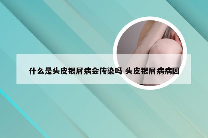 什么是头皮银屑病会传染吗 头皮银屑病病因
