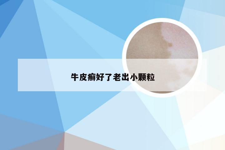 牛皮癣好了老出小颗粒