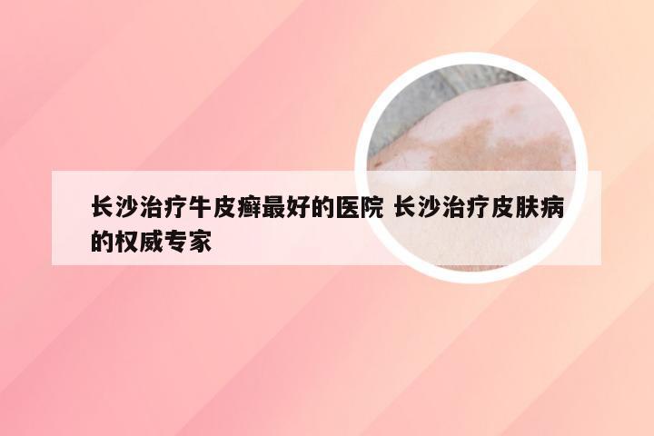 长沙治疗牛皮癣最好的医院 长沙治疗皮肤病的权威专家