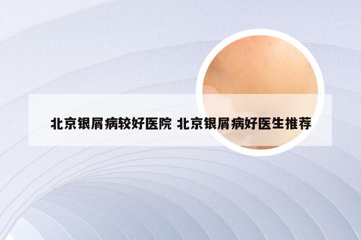 北京银屑病较好医院 北京银屑病好医生推荐