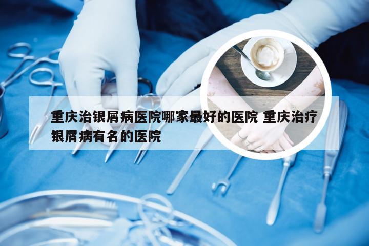 重庆治银屑病医院哪家最好的医院 重庆治疗银屑病有名的医院