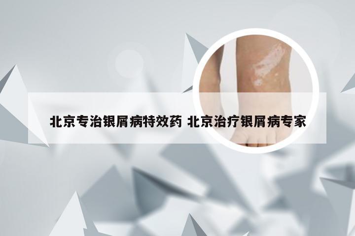 北京专治银屑病特效药 北京治疗银屑病专家