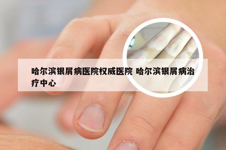 哈尔滨银屑病医院权威医院 哈尔滨银屑病治疗中心