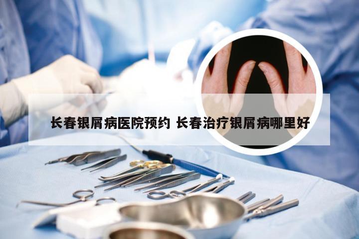 长春银屑病医院预约 长春治疗银屑病哪里好