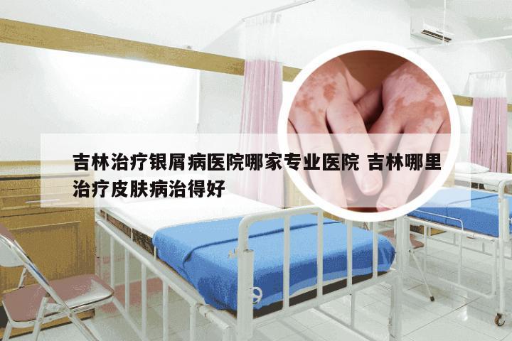吉林治疗银屑病医院哪家专业医院 吉林哪里治疗皮肤病治得好