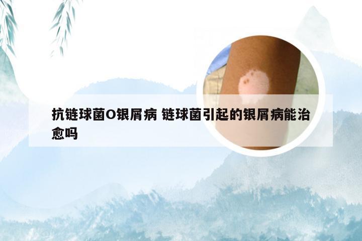 抗链球菌O银屑病 链球菌引起的银屑病能治愈吗