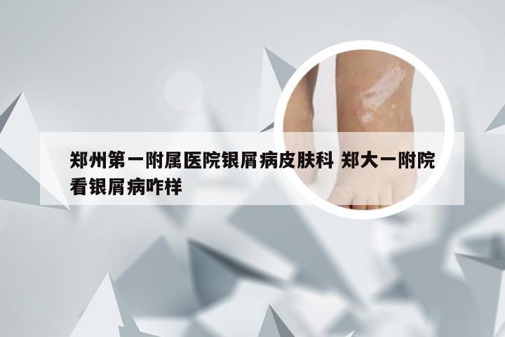 郑州第一附属医院银屑病皮肤科 郑大一附院看银屑病咋样