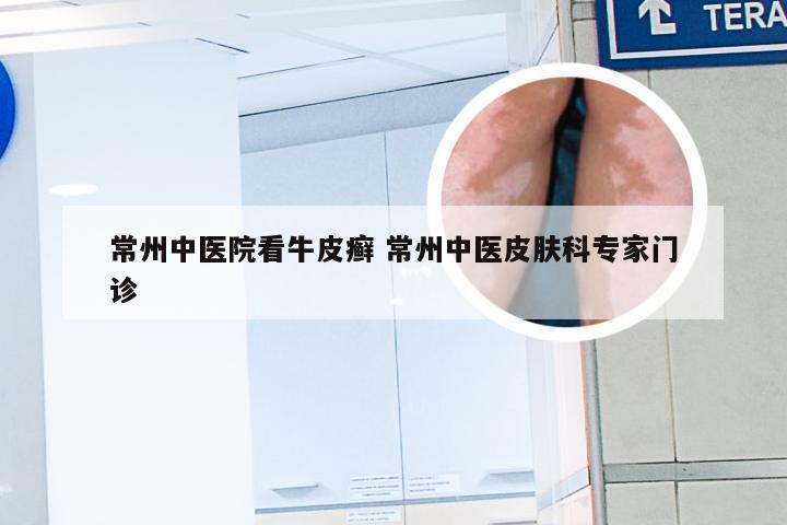 常州中医院看牛皮癣 常州中医皮肤科专家门诊