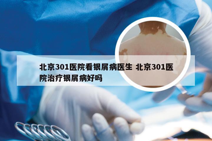 北京301医院看银屑病医生 北京301医院治疗银屑病好吗