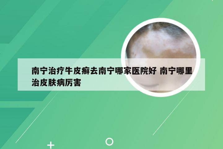 南宁治疗牛皮癣去南宁哪家医院好 南宁哪里治皮肤病厉害