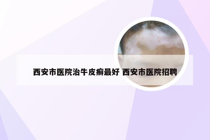 西安市医院治牛皮癣最好 西安市医院招聘