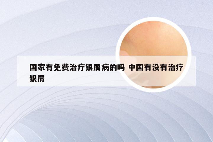 国家有免费治疗银屑病的吗 中国有没有治疗银屑