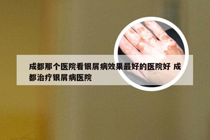 成都那个医院看银屑病效果最好的医院好 成都治疗银屑病医院
