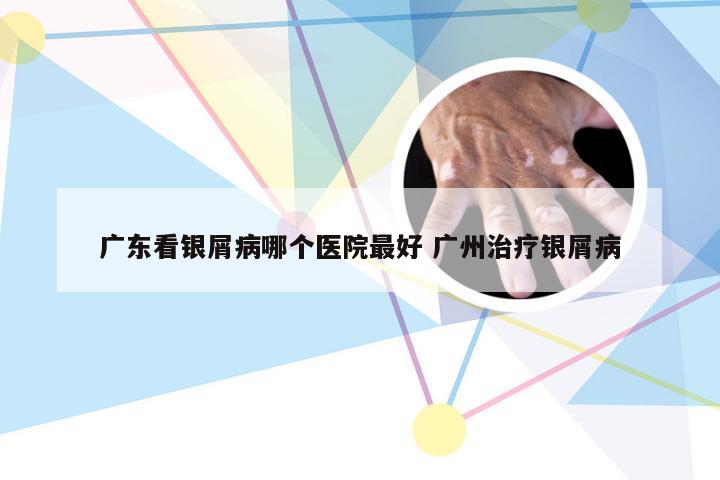 广东看银屑病哪个医院最好 广州治疗银屑病