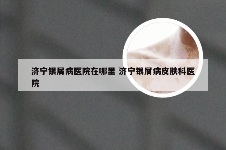 济宁银屑病医院在哪里 济宁银屑病皮肤科医院