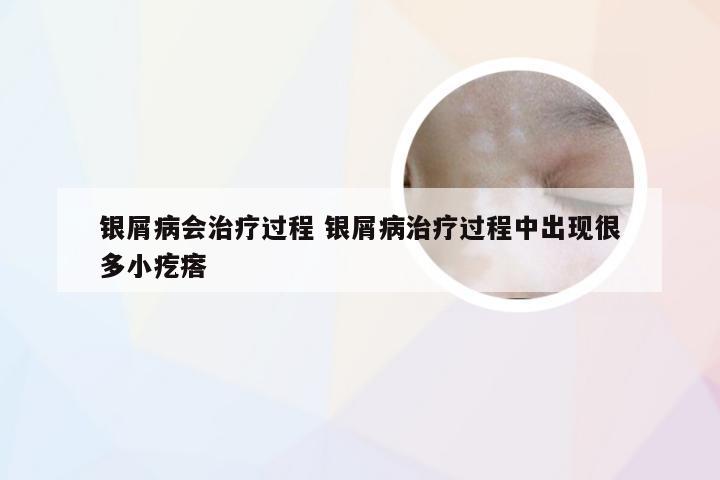 银屑病会治疗过程 银屑病治疗过程中出现很多小疙瘩