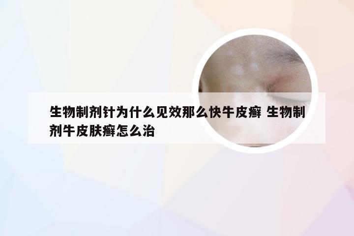 生物制剂针为什么见效那么快牛皮癣 生物制剂牛皮肤癣怎么治