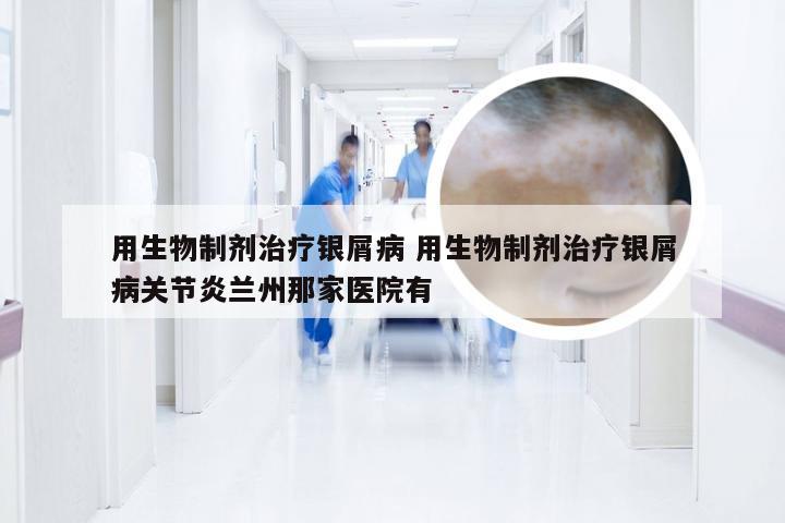 用生物制剂治疗银屑病 用生物制剂治疗银屑病关节炎兰州那家医院有
