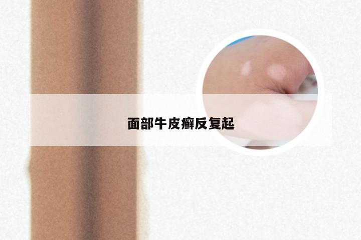 面部牛皮癣反复起