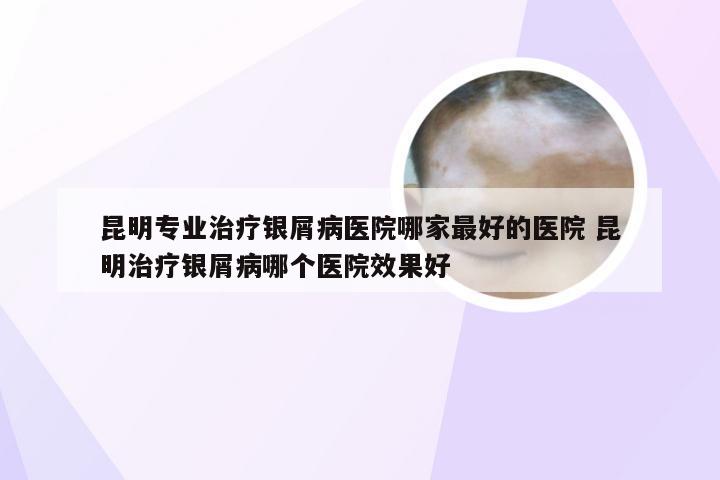 昆明专业治疗银屑病医院哪家最好的医院 昆明治疗银屑病哪个医院效果好
