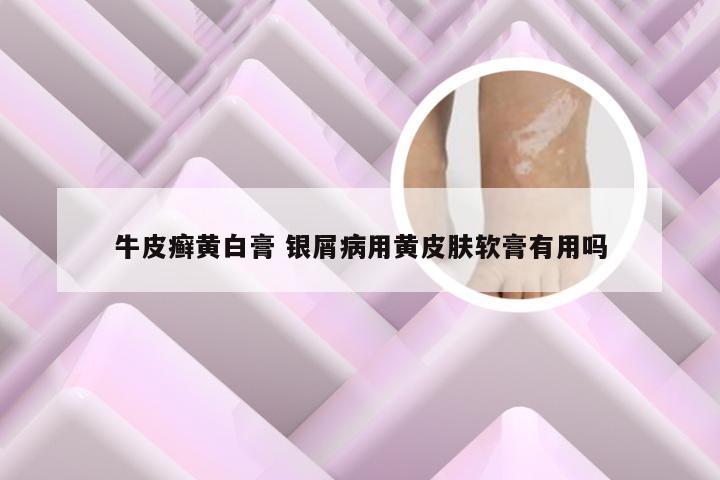 牛皮癣黄白膏 银屑病用黄皮肤软膏有用吗