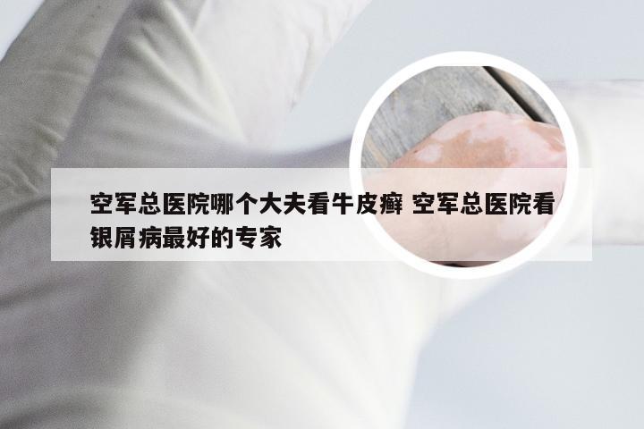 空军总医院哪个大夫看牛皮癣 空军总医院看银屑病最好的专家