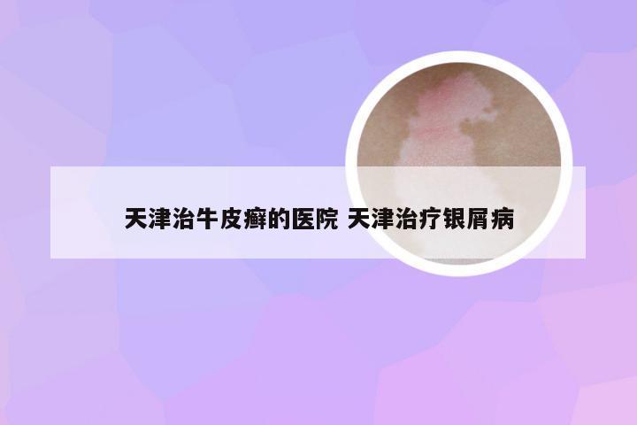 天津治牛皮癣的医院 天津治疗银屑病
